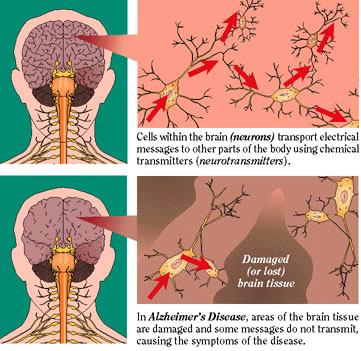 20100303175837-alzheimers-disease