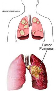 cancer_carcinoma_microcitico_pulmonar http://nuevamedicinahamer.com